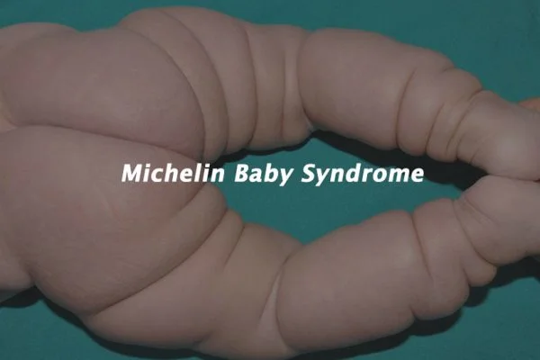 Understanding Michelin Baby Syndrome (MTBS): Causes, Symptoms and Treatment