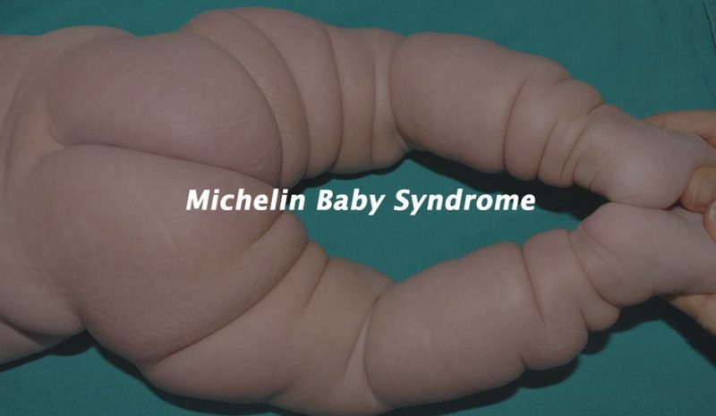 Understanding Michelin Baby Syndrome (MTBS): Causes, Symptoms and Treatment