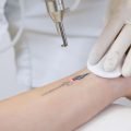Faster Recovery After Tattoo Removal