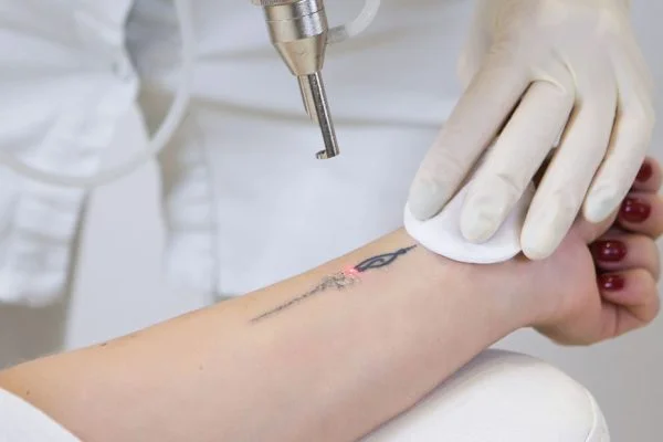 Post-Care Tips for Faster Recovery After Tattoo Removal
