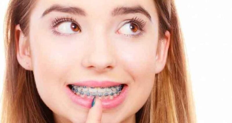 Orthodontist Spotlight: Lingual Braces – Hidden Orthodontic Solutions in Las Vegas