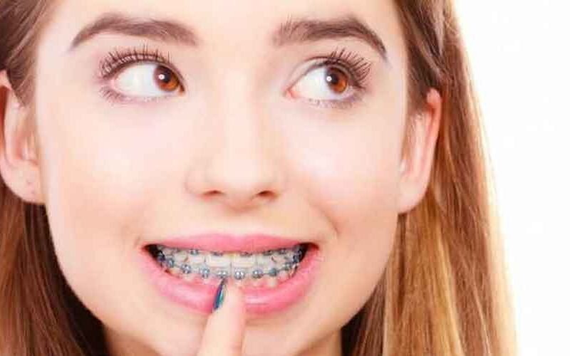 Orthodontist Spotlight Lingual Braces Hidden Orthodontic Solutions
