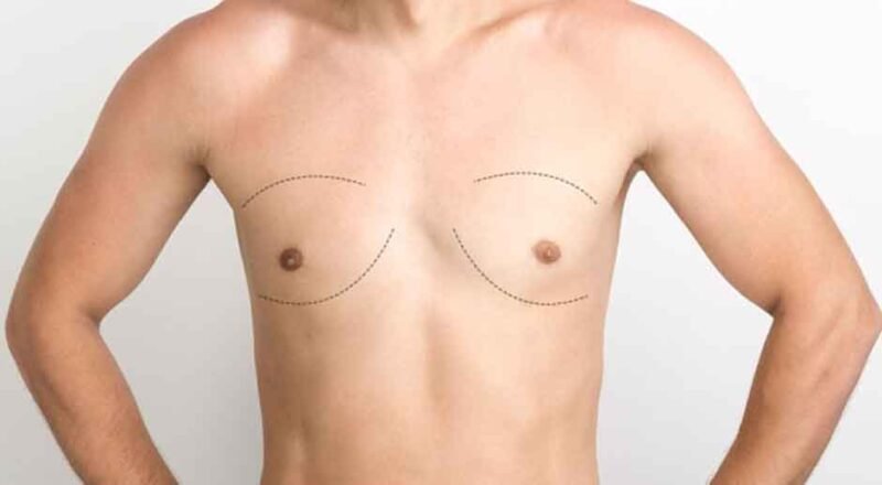 How Gynecomastia Surgery Can Improve Your Life