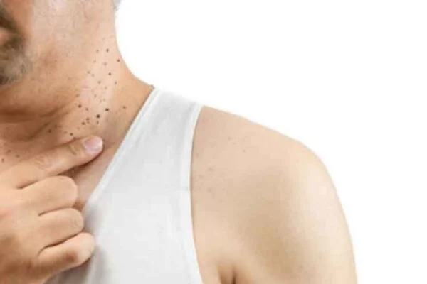 Comprehensive Guide to Skin Tag Removal in Toronto