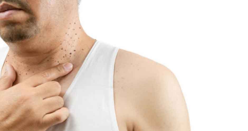 Comprehensive Guide to Skin Tag Removal in Toronto - BlueSmartMia