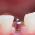 Tips-for-Selecting-the-Best-Full-Mouth-Dental-Implant-Specialist