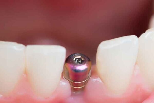 The Art of Smile Reconstruction: Tips for Selecting the Best Full Mouth Dental Implant Specialist