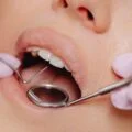 Exploring Dental Implants