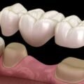 Types of Dental Restorations