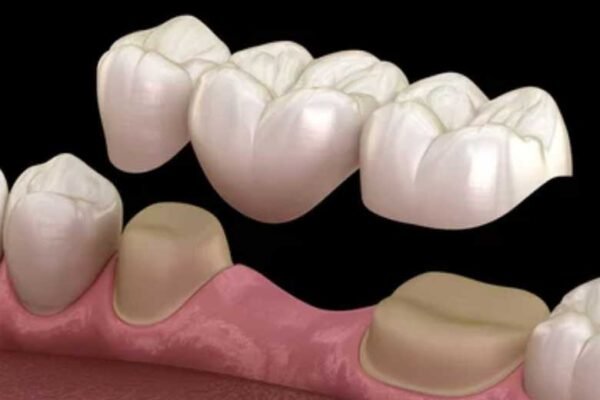 Types of Dental Restorations