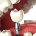 Dental-Implants-and-Oral-Health-What-You-Should-Know
