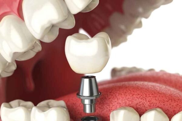 Dental Implants and Oral Health: What You Should Know