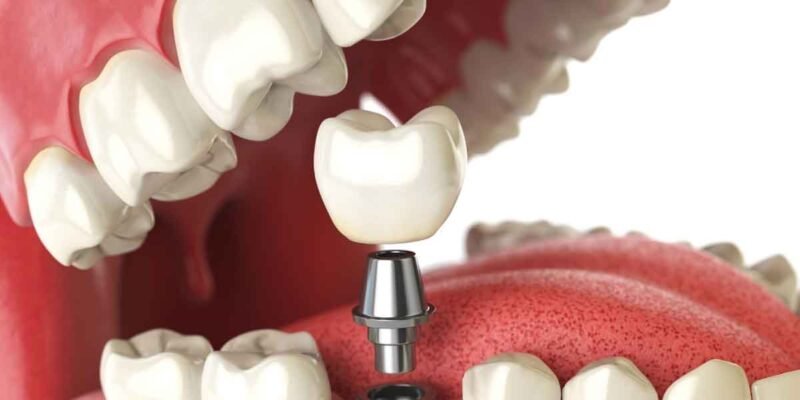 Dental Implants and Oral Health: What You Should Know