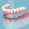 how-modern-dental-implants-are-transforming-smiles-1