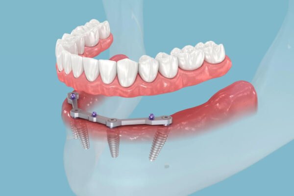 How Modern Dental Implants Are Transforming Smiles