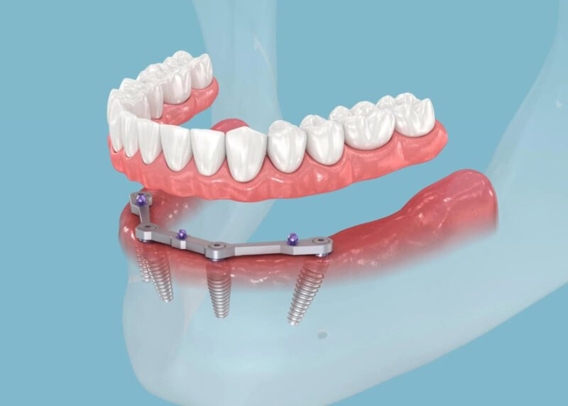 How Modern Dental Implants Are Transforming Smiles