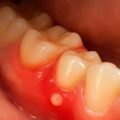 Mouth Pain After Wisdom Teeth or Sores