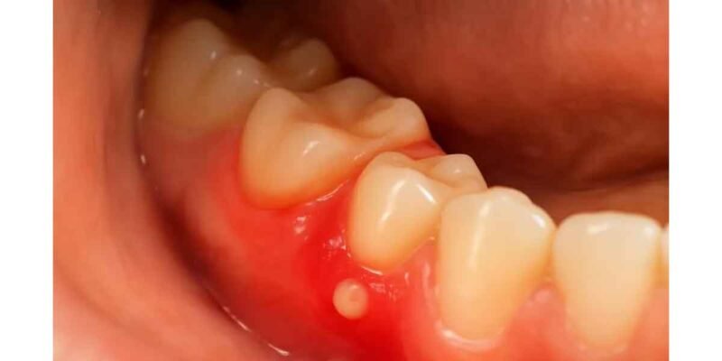 Mouth Pain After Wisdom Teeth or Sores: What Healing Should Look Like